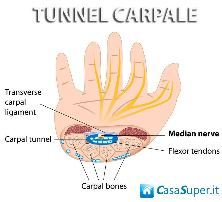 infografica tunnel carpale