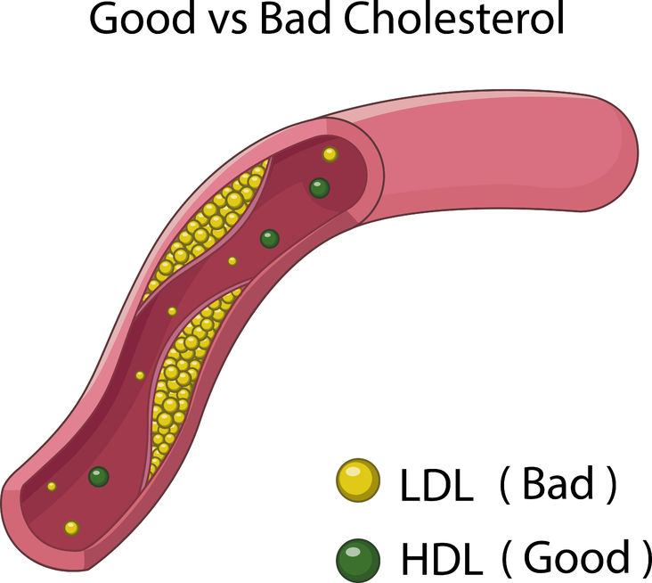 vena ostruita dal colesterolo LDL