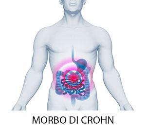 Morbo di Crohn