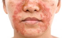 Dermatite seborroica: cos’è, sintomi, cause, cure